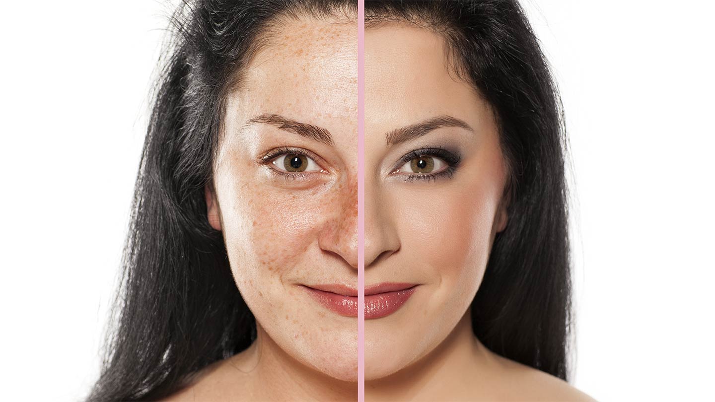 wrinkle reduction laser treatment melbourne