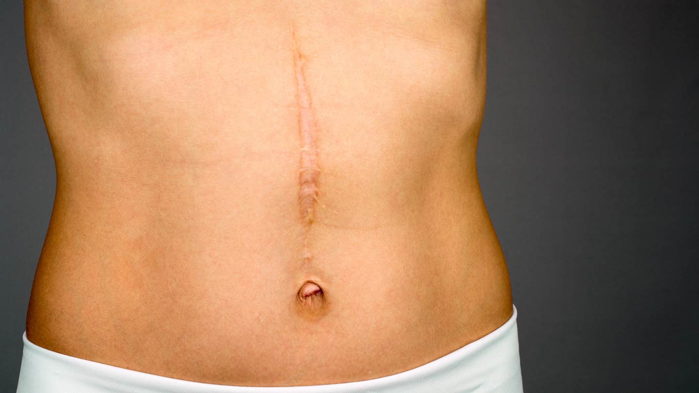 Laser Scar Removal melbourne