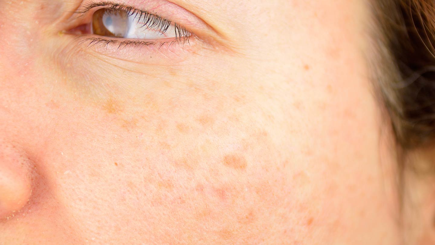 Laser Sun Spot Removal melbourne